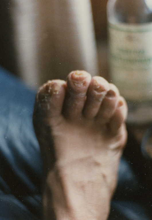 Odmrożone stopy Jerzego Kukuczki po zejściu z Cho Oyu.